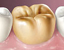 Full cast gold crown.