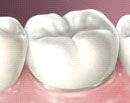 Full porcelain fused to metal.